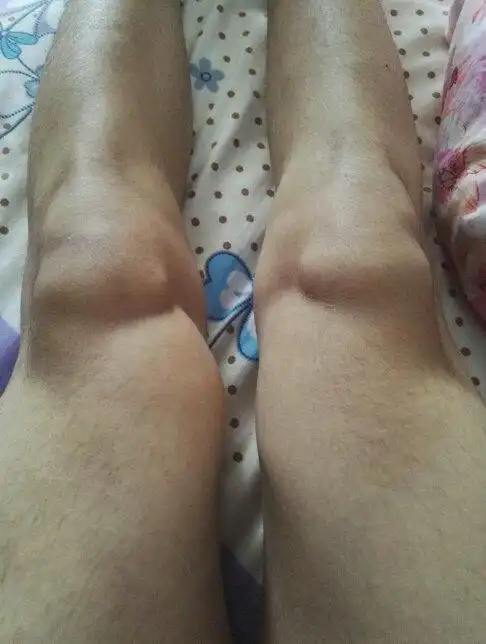 膝盖鼓出了一块,没有任何感觉,这正常吗,我以前去健身房练过肌肉,会不
