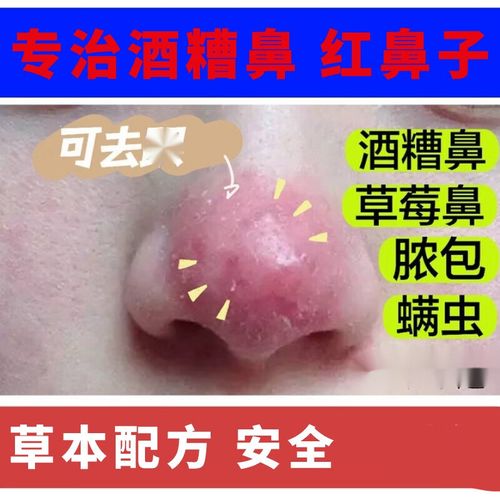 酒糟鼻专用非药鼻子红血丝草莓鼻红痒两侧泛红毛孔粗大 二支修复