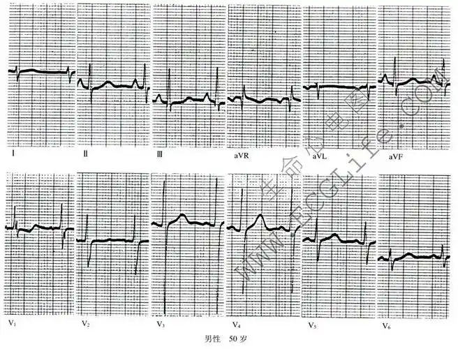 右心室肥大心电图表现