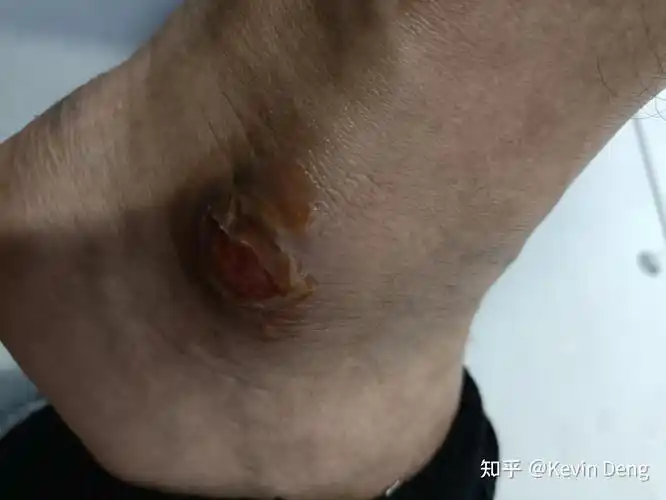 艾灸烫伤三度烫伤恢复记录