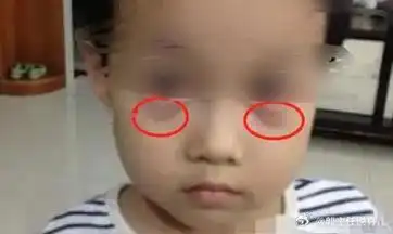 脾虚积食了1,面色黯黄,有黑眼袋正常的宝宝面部一般都是红润有光泽的