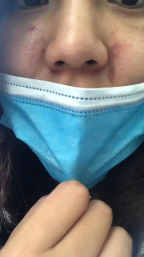 当时一个小姑娘做完果酸灼伤的效果,建议还是尽量选择_圈子-新氧美容