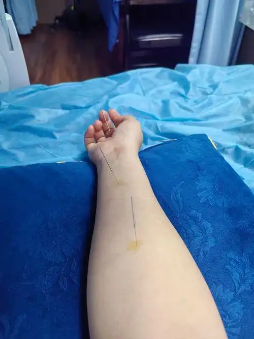 真该死啊没有竞人的命得了竞人的病针灸有图慎入哈