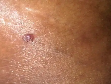 尖锐湿疣长在阴囊皮肤上,阴茎龟头上会有病毒吗?