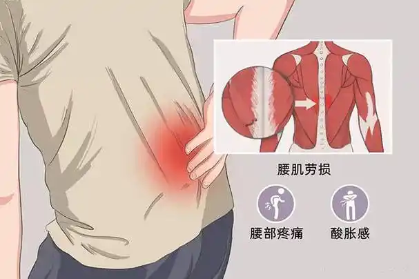 手法松解肌肉缓解疼痛_治疗_方法_腰部