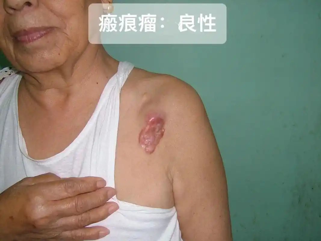 病理学 #皮肤 #瘤子 #结核 #鳞癌 三种常见的皮肤瘤样 - 抖音