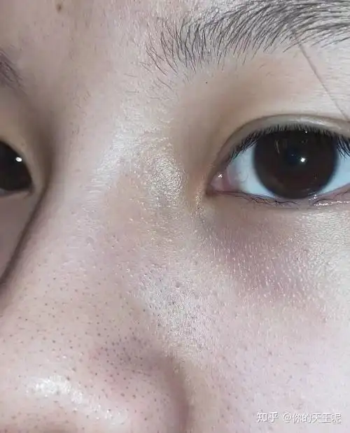 水杨酸可以去鼻子上黑头和t区毛孔粗大吗怎么使用一天几次