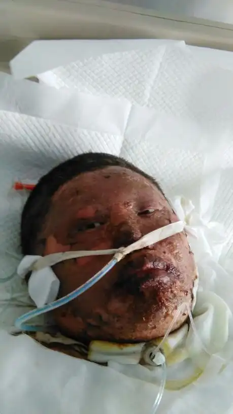 我妹妹被烧伤高达百分之八十以上,需要巨额的医疗费,我们找工作单位的