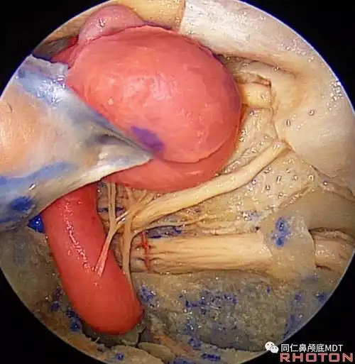 颈内动脉internalcarotidartery解剖