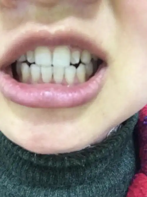 请问这个大门牙两边的牙齿很小在风水上有什么不好处.