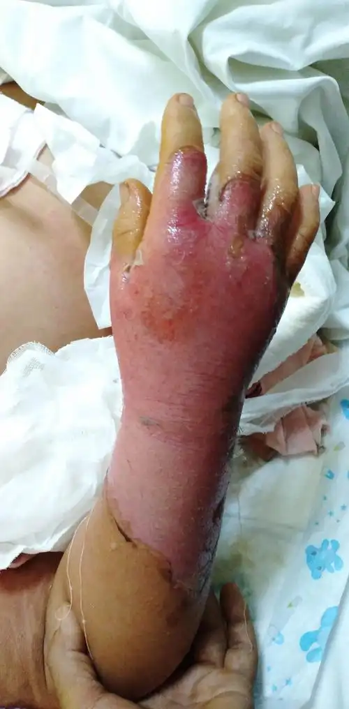 11床 热油导致全身45%面积烧伤