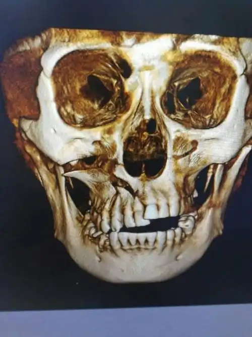 我在工地上第二个班,石头落下碰到嘴上,使右上颌骨粉碎骨折,牙齿脱落