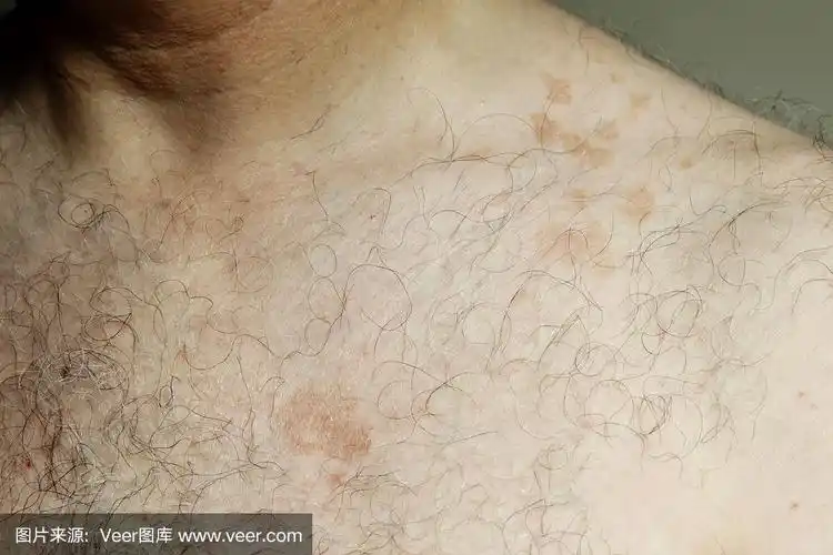 皮肤问题-男人胸部的花斑糠疹