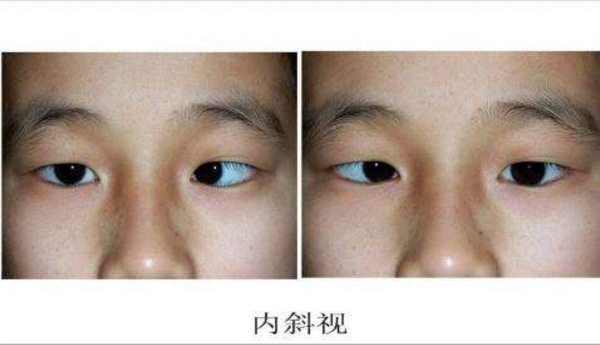 急性内斜视
