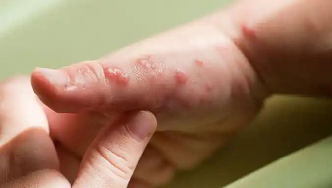 两个月宝宝湿疹的症状都有哪些两个月大宝宝患有湿疹怎么进行治疗