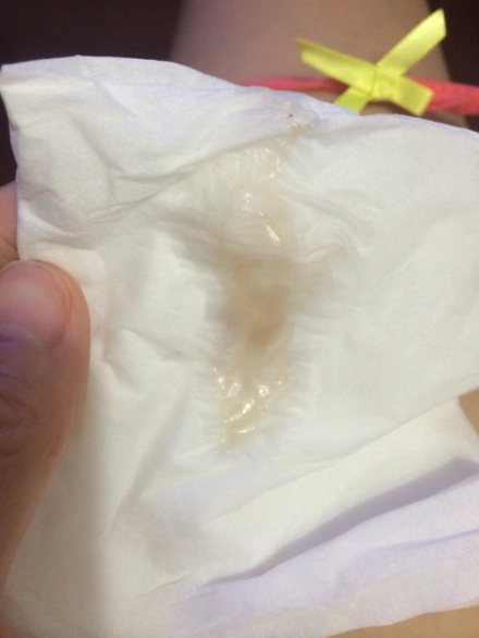 怀孕白带褐色怀孕初期白色呈褐色怎么办怀孕35天白带里有褐色分泌物有