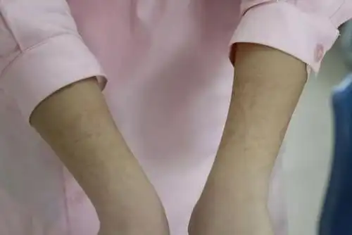 曝光共青城隔离区医护人员工作状态身上勒痕让人心疼