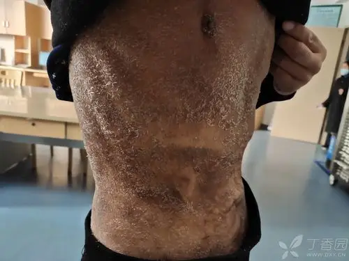 我科一位胃癌患者术后辅助xelox方案,服用替吉奥之后出现全身皮肤痒