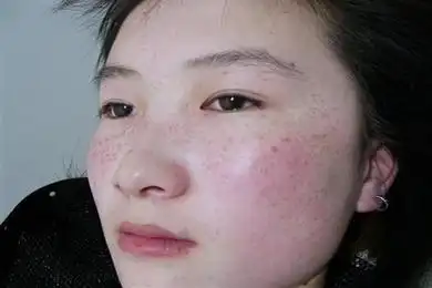 治疗汗斑有什么小妙招-人体健康加油站