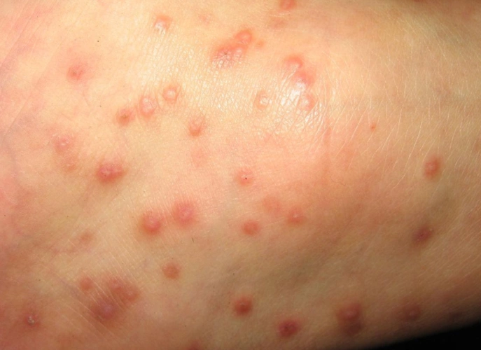 【皮肤病图片】_种类_症状表现_苹果绿