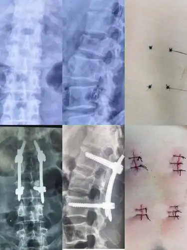 腰2椎体压缩性骨折,闭合复位微创经皮钉棒系统内固定手术治疗.