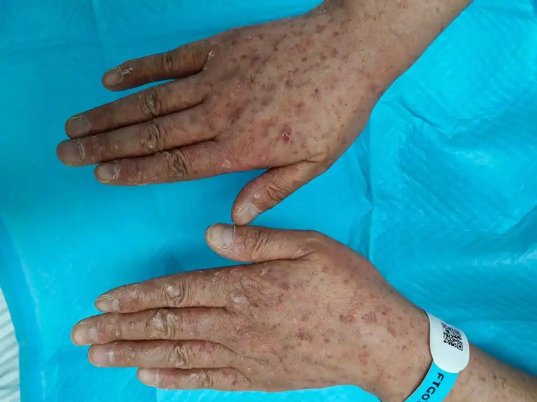 喝中药喝出皮肤癌?这种是砷角化病,右手掌部的结节被证实为恶 - 抖音