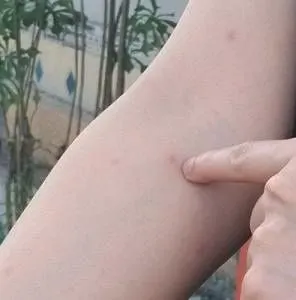 床虱叮咬的迹象