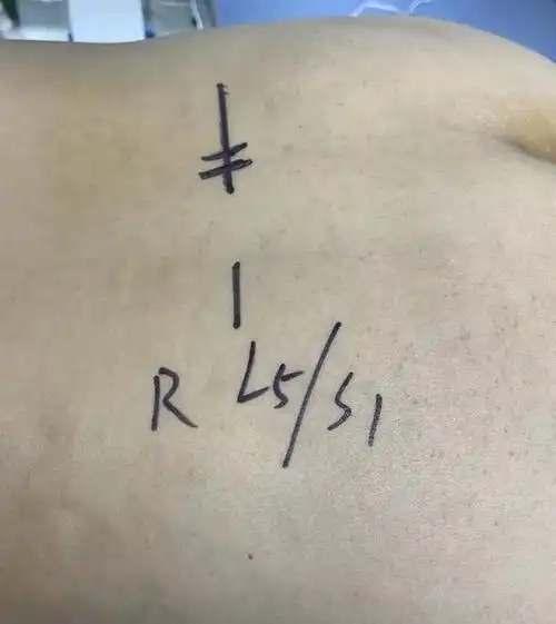 手术透视定位术前ct检查:l5/s1椎间盘突出,黄韧带肥厚.