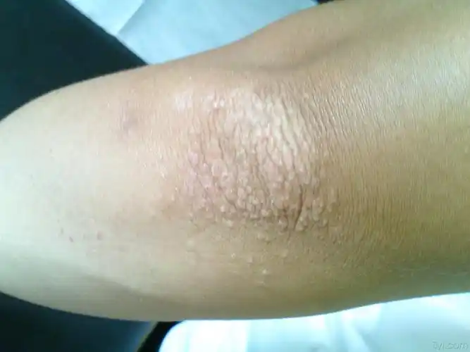 双手肘关节出现丘疹瘙痒一周