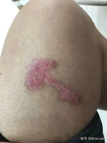 被开水烫伤大腿八天的恢复情况