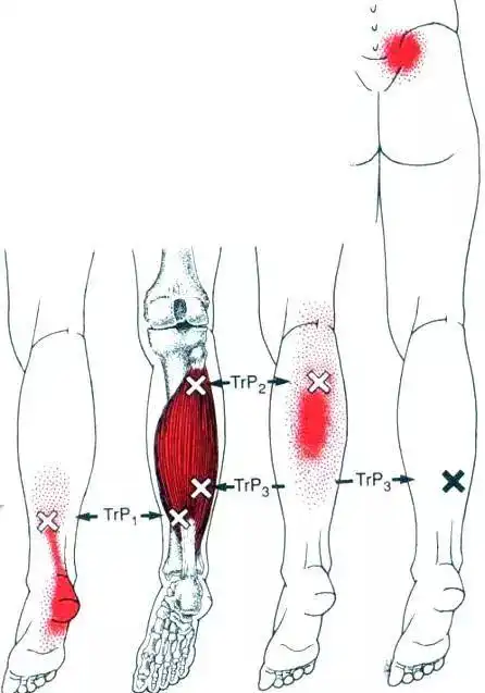 瘦小腿,缓解足底筋膜炎的日常方法