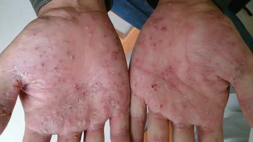 掌跖脓疱病