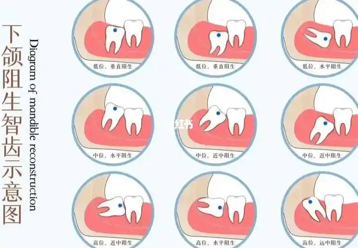 形态不一的下颌阻生智齿