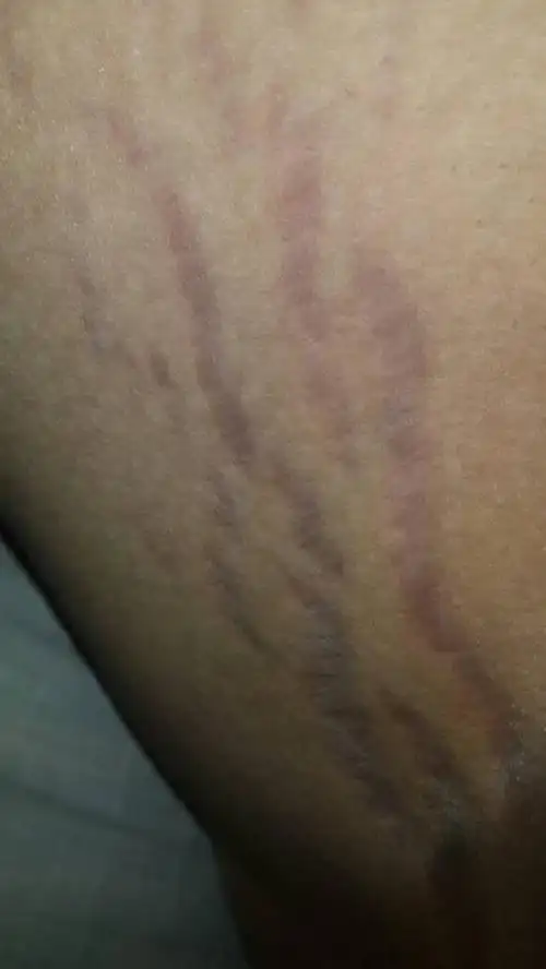 大腿内侧起了一条一条的红印!摸上去凹下去,感觉里面的肉没了!