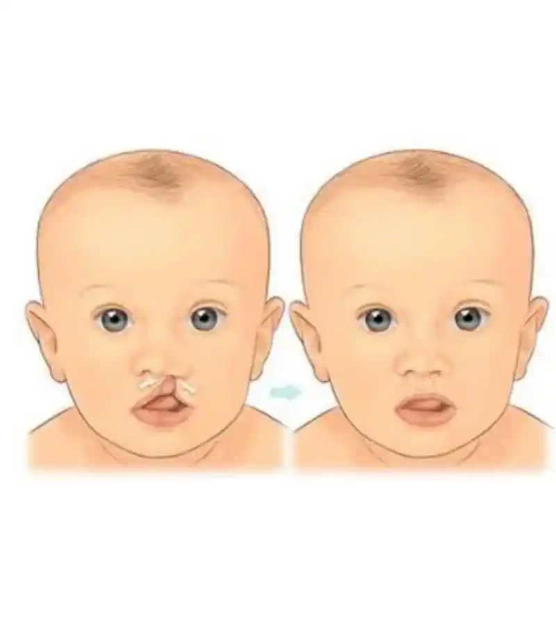 针对兔唇问题,唇裂畸形手术是一种常见的治疗方法,可以有效改善唇部的