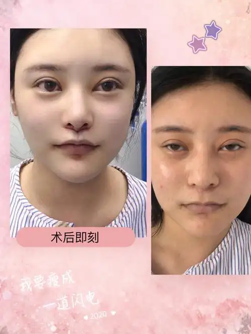 来做了人中的修复~~一年前在上海做的人中缩短,_圈子-新氧美容整形