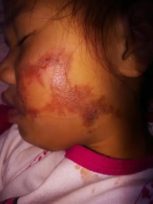 您好:孩子已经5岁了,烫伤有两天了,像他这样的情况会留疤吗?