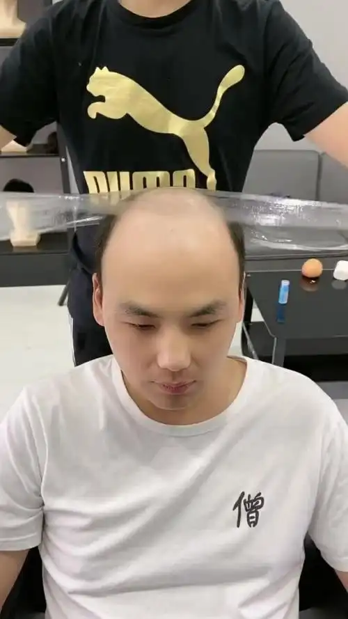 帅哥才二十六岁就秃顶了,程序员确实有点费头发