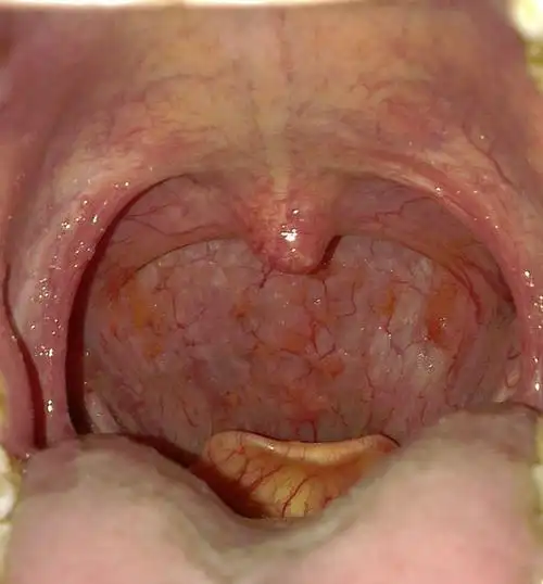 天喉咙干 疼 痒 有痰 昨天卡出来的痰 是血 用手机照了下 发现舌头根