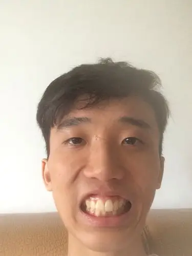 门牙太大太长,而且还外突怎么办?