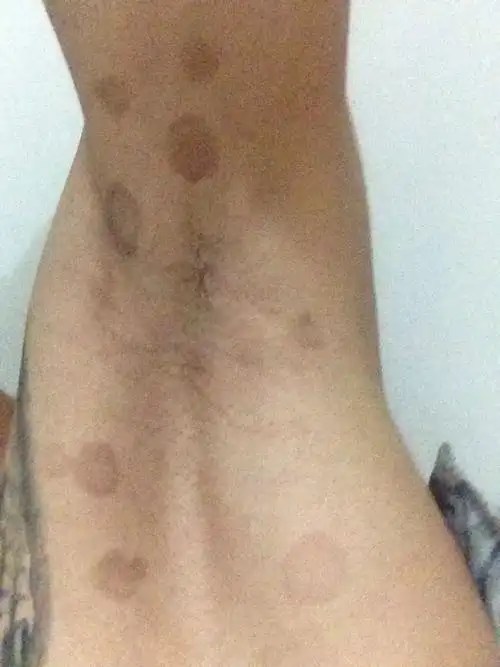 我腋下的这些是花斑癣吗?不痒不痛的,用什么药物可以治?