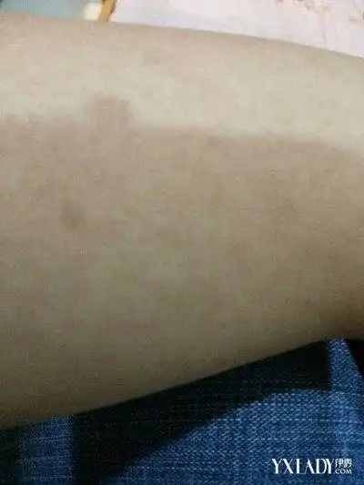 手臂上长斑什么原因6个妙招让你去除手臂上的斑