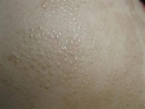 看图识病不痛不痒的小疹子