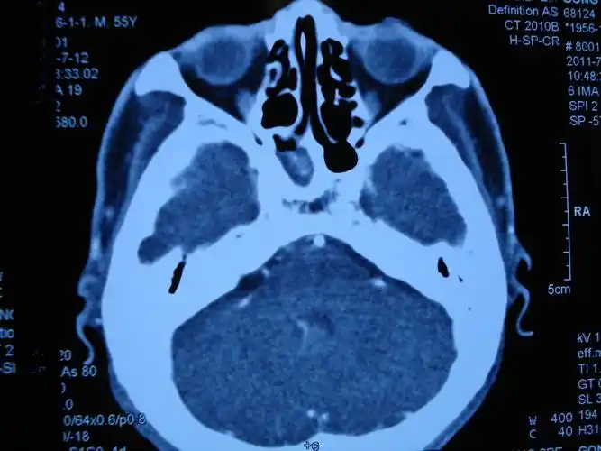 真菌性蝶窦炎 - 好大夫在线