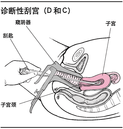 诊断性刮宫(d和c)