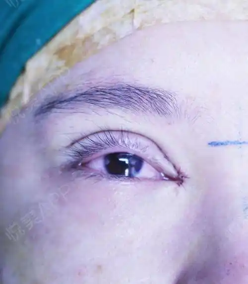 开眼角手术当天_双眼皮手术当天_眼部整形手术当天_悦mer_8569875428