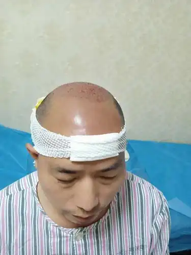 手术完成包扎的模样!