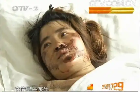 长宁路车祸受伤女孩性情大变 医生助其走出阴影