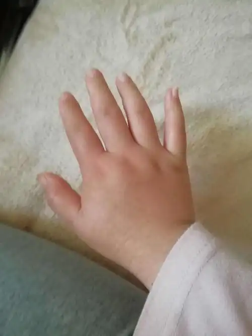 手红肿,一片红色,肿起来,指关节上面也有哦,不是很疼,有点痒