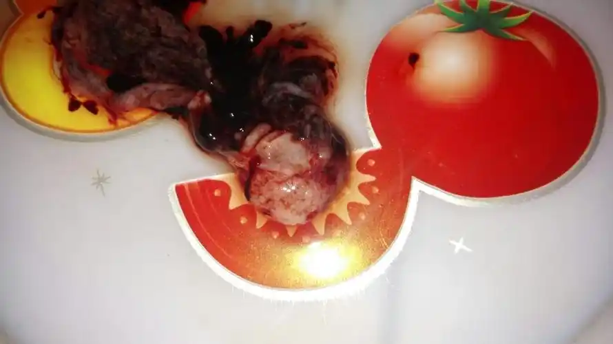 生化流出的胚胎图,自然流产流出的胚胎图-图片大观-奇异网